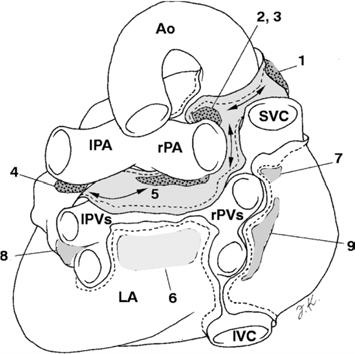Pericardial Attachments 1-5 Transverse sinus 1. Anterior portions of superior aortic recess 2. Posterior portions of superior aortic recess 3. Inferior aortic recess 4.