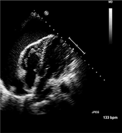 Tamponade 2-D Echocardiographic RA inversion Normally rounded throughout cardiac cycle Sensitivity 90 + %