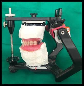 The splint was incorporated in the complete denture for the mandibular arch designed so to offer bilateral contacts of all posterior teeth in centric relation and guides of the anterior teeth in