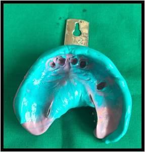 Fig. 5: Final impression Fig. 6: Metal coping trial Fig. 7: Maxillary final prosthesis DISCUSSION Mouth rehabilitation has been definitely come of age.