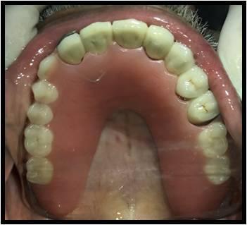 Most philosophies and associated techniques for full mouth rehabilitation share similar characteristics: (1) They are based on the specific philosophy of occlusion according to the author, and (2)