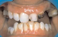 CHIEF COMPLAINT A 45 year old female patient reported to our dental office with severe pain in upper anterior teeth.