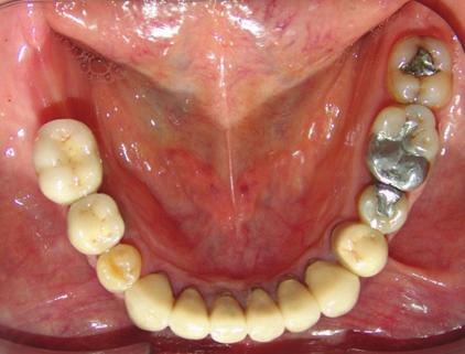 The causes of the severe wear were parafunctional habits, unsuitable restorations, and a lack of stable posterior occlusion. 2.2. Treatment.