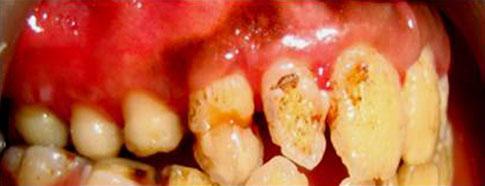 36, 44, 45, 46, as the clinical crown length was reduced and this would lead to pulp exposure during tooth preparation for the placement of final restoration.