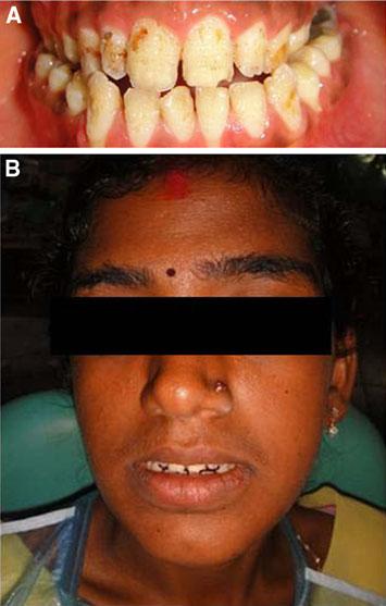 244 J Indian Prosthodont Soc (Oct-Dec 2010) 10(4):240 245 philosophy of full mouth rehabilitation was used for the restoration of all teeth [17].