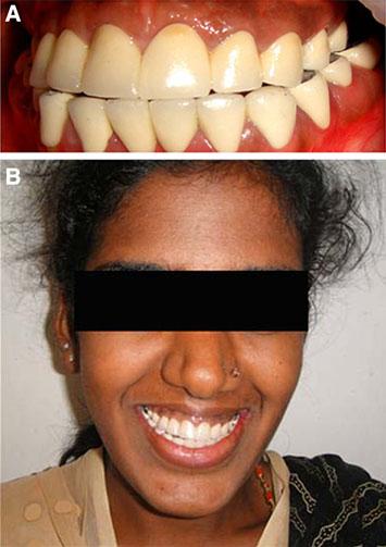 The patient was comfortable with the temporary restorations and the final restorations were also fabricated using the same putty indices.