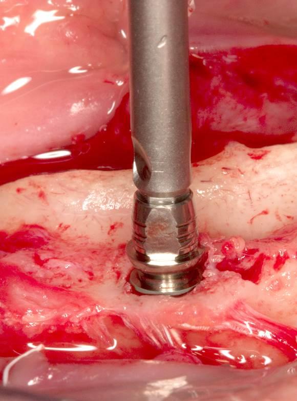 manually. Fig. 11: the implant is then driven into its final position using the isy Torque wrench.