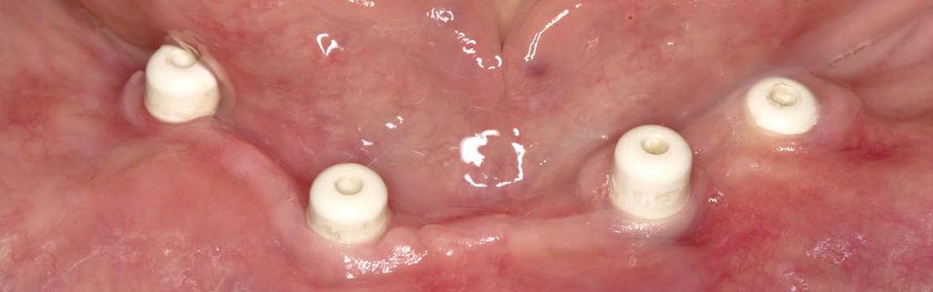 sutured peri-implant free of saliva.