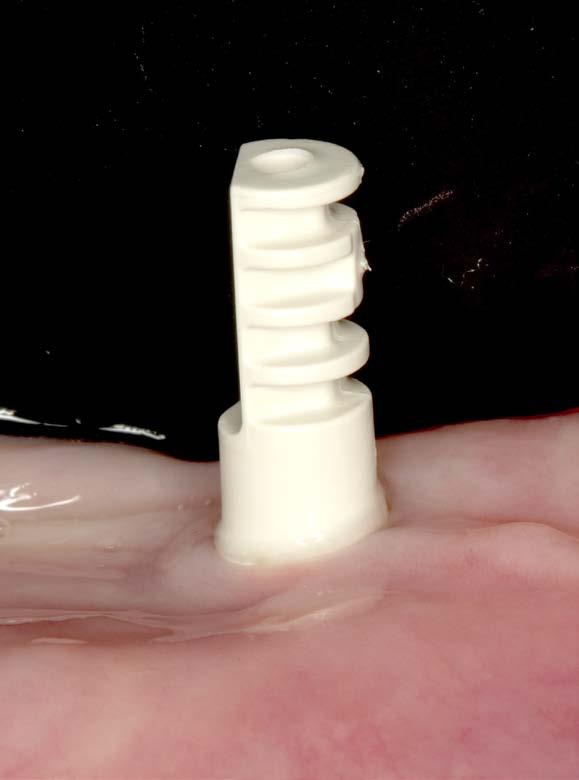 in the set together with the isy Implant (with pre-mounted implant base)