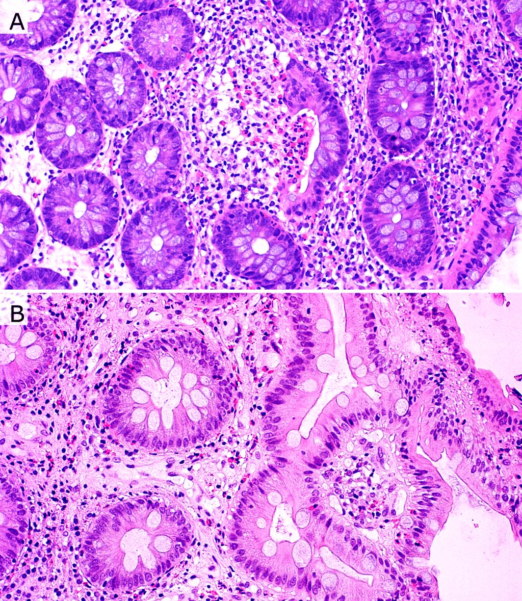 Cristin Díz Del Arco et l. 786 nd extensive eosinophil degrnultion. Lymphoid folliculr hyperplsi ws detected more frequently in cses with men number of 40 eosinophils per HPF.