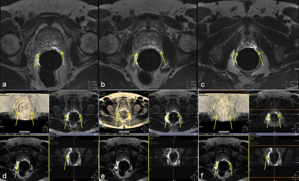 Fig. 4: Fig. 4: 2D T2 weighted axial images (TR = 8500, TE = 110, FA = 110) show: prostate gland at base level (a), middle (b) and at the apex (c). 3D T2 weighted images (TR = 4.9, TE= 2.