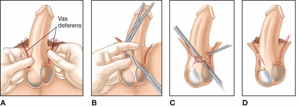 Vasectomy Figure 12.