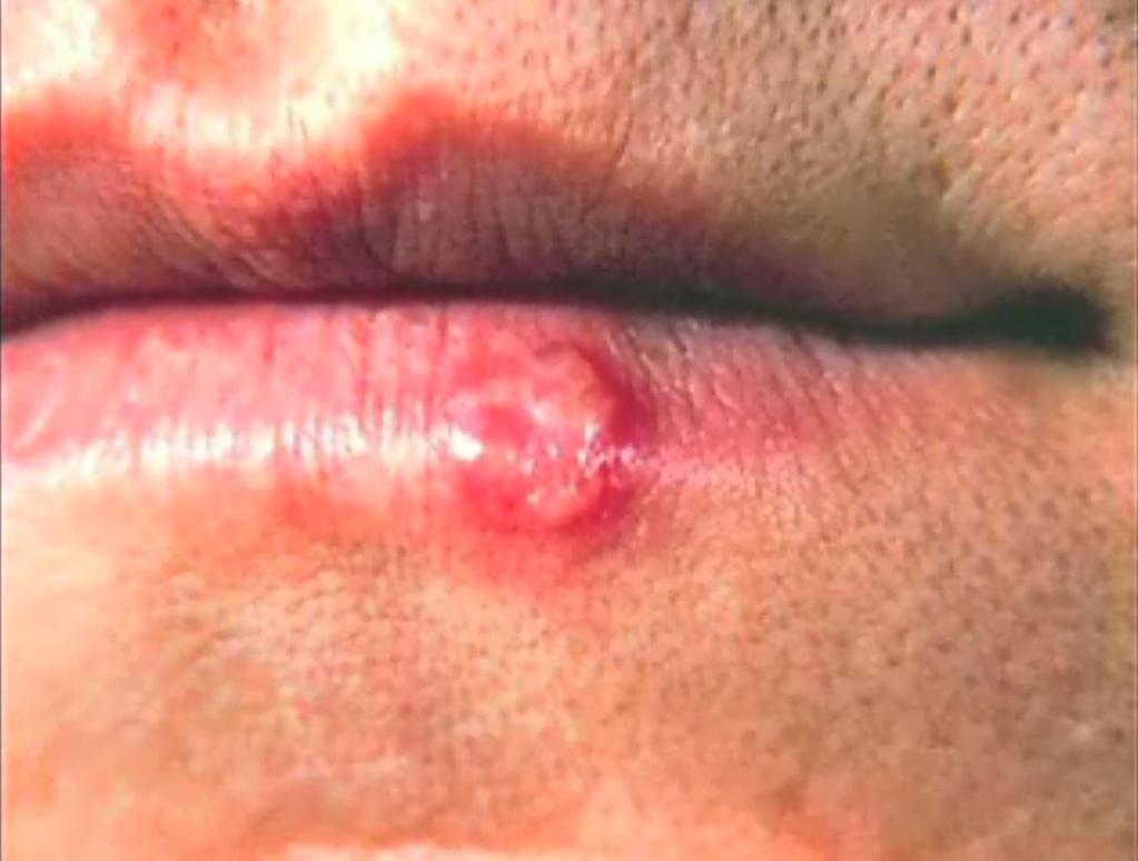 Genital Herpes Video Click on the image in presentation mode to view a video