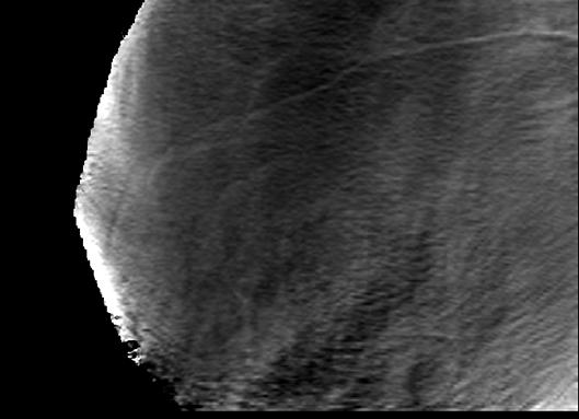 inferior breast, resulting in