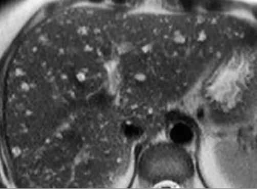 17 Focl Liver Lesions 183 17.5 Mlignnt Primry Tumors 17.5.1 Heptocellulr Crcinom Fig. 17.10 Biliry hmrtoms (von Meyenurg complex). A middleged womn ws referred to MRI following n ultrsound exmintion.