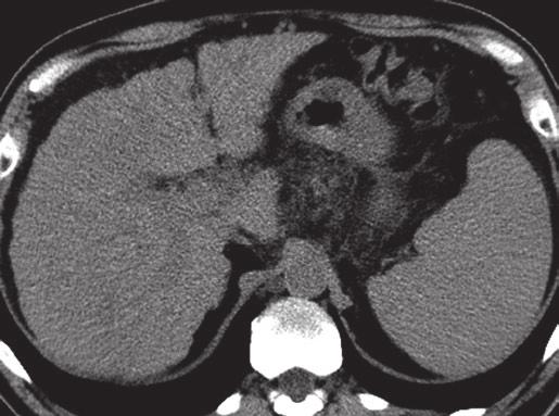 17 Focl Liver Lesions 185 Fig. 17.12 HCC: qudruple-phsic CT for detection nd chrcteriztion. () Non-contrst CT shows liver cirrhosis nd splenomegly. In segment 4, lesion is only fintly seen.