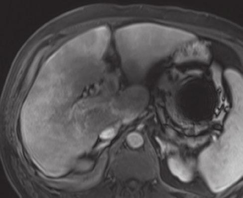 17 Focl Liver Lesions c Fig. 17.14 Diffuse HCC in the right loe with tumor thromus in the portl vein.