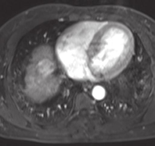 188 W. Schim et l. c Fig. 17.15 HCC: MRI with liver-specific contrst gent (gdoxetic cid). () Axil T1-weighted GRE shows n encpsulted slightly hyperintense mss in the dome of the liver.