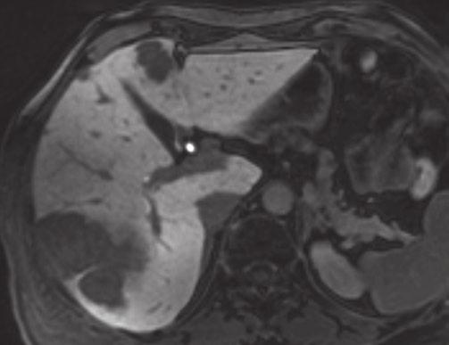 FNH is most likely in young women with non-cirrhotic liver nd if the lesion is homogeneous nd ner-isodense/ner-isointense on unenhnced CT/MR imging with centrl T2-weighted hyperintense scr.
