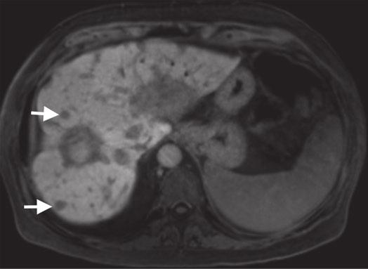 17 Focl Liver Lesions In- nd opposed-phse (or out-of-phse) T1-weighted imging is recommended for mximl tumor detection nd for chrcteriztion of ft contining tumors nd the presence of stetosis.