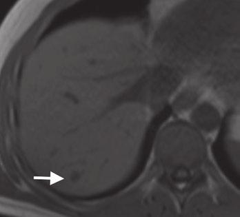 A 45-yer-old womn with incident lesion (rrows) in the