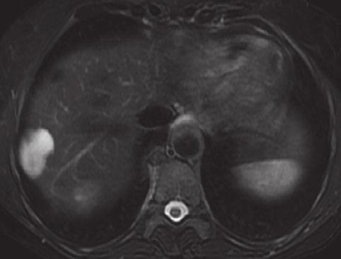 178 W. Schim et l. c d Fig. 17.5 Hemngiom type 3: liver-specific MR contrst gent. () T2-weighted TSE shows lrge loulted lesion of very high signl intensity.