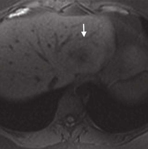 17 Focl Liver Lesions 179 c d Fig. 17.6 FNH. Incidentl lesion in the left loe of the liver (rrows).