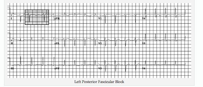 Identifying Hemiblocks What to look for in what leads Fasicular