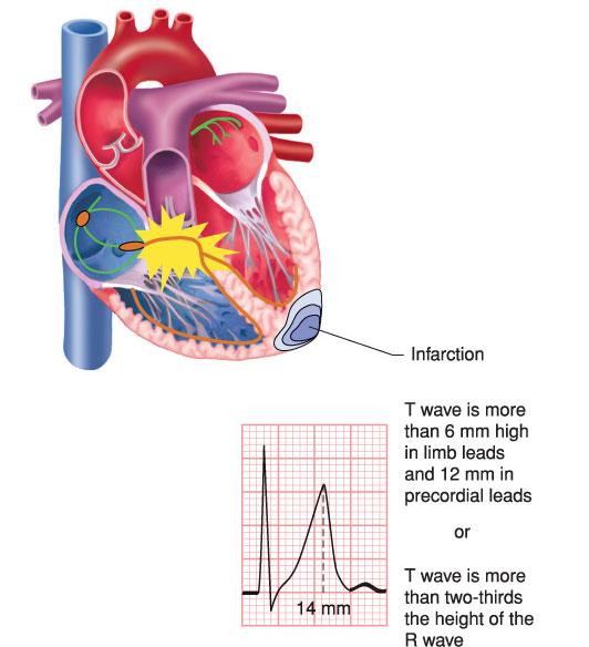 May be seen in early stages of acute myocardial