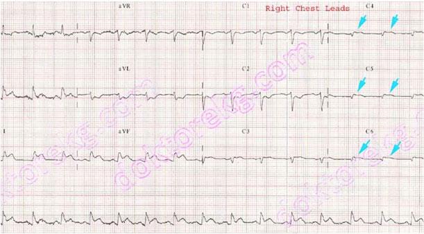 Other MI s Right Ventricular Infarct Indicative leads: V 3-6R (II, III, avf) Reciprocal leads: I avl Complications: Right