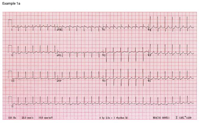 AVNRT Most common cause of palpitations in pts with structurally normal hearts Occurs spontaneously or upon provocation (caffeine, ETOH, Beta agonists, sympathomimetics (amphetamines) More common in