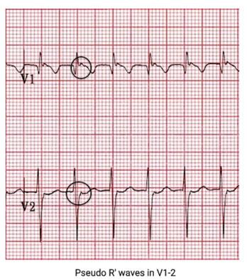 Typical AVNRT Narrow complex Tachycardia No visible P
