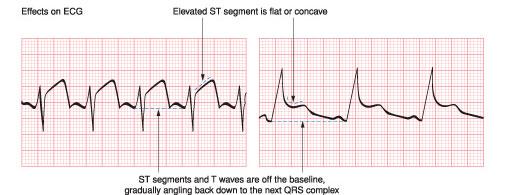 ECG Changes in Pericarditis T wave initially upright and elevated