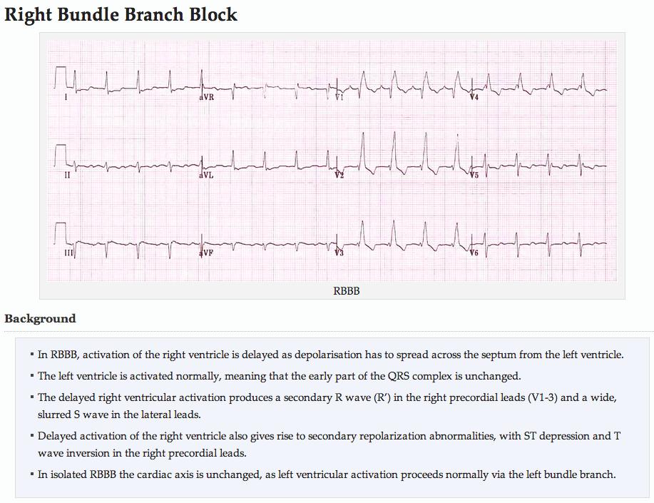with RBBB QRS > 0.