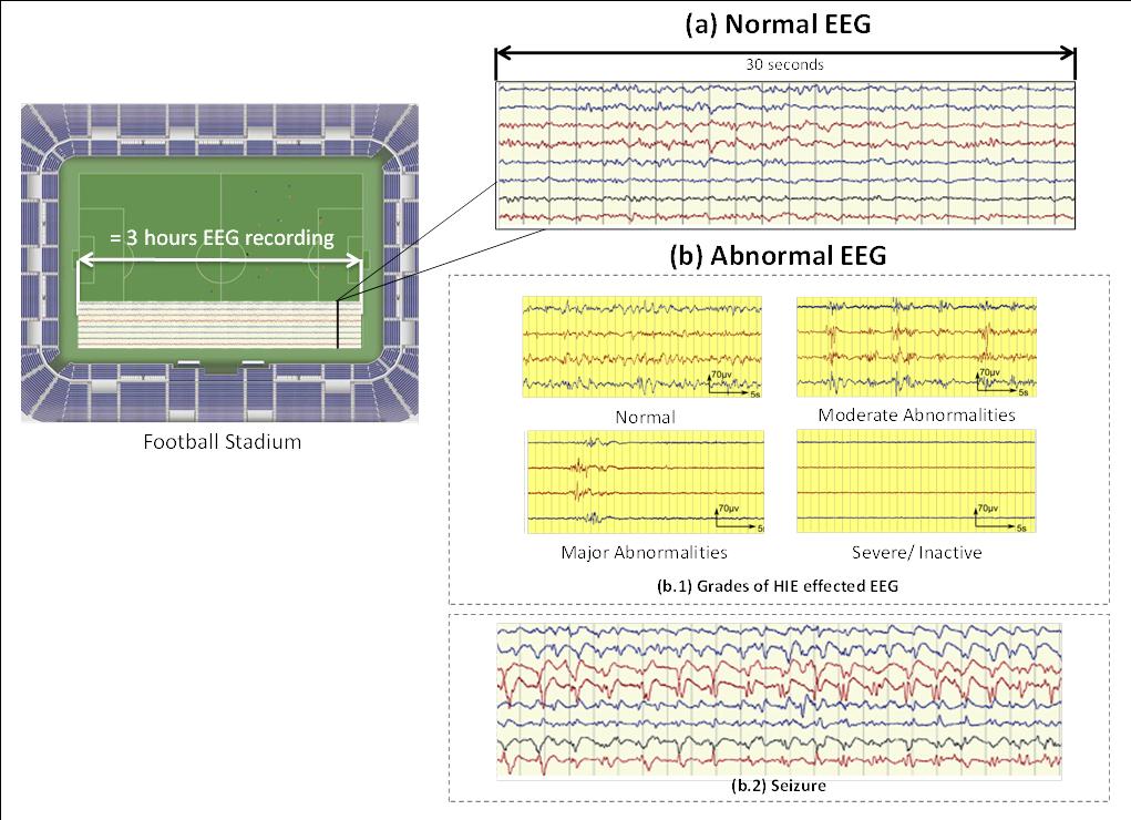 Automated System for Detecting Neonatal Brain Injuries REHAN AHMED Figure 2: Examples of Normal and Abnormal EEG. Source: Author different EEG features are extracted.