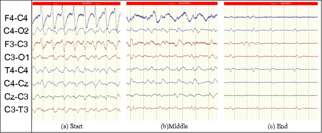 Automated System for Detecting Neonatal Brain Injuries REHAN AHMED Figure 4: Changes in a seizure pattern in time. Source: Author evolution of these features in a given sequence.