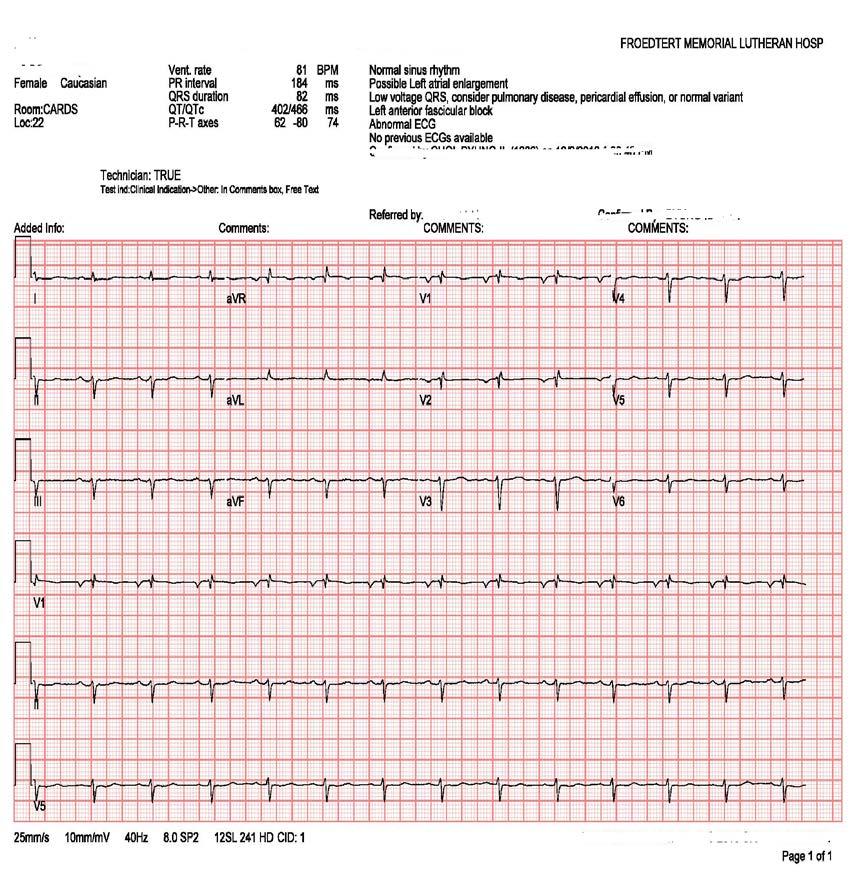67 year old WF with presents with dyspnea on exertion 2 months, intermittent, resolves with rest EKG, Stress test, echocardiogram and