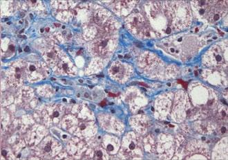 (C) The characteristic pericellular/perisinusoidal chicken wire pattern of fibrosis surrounding centrilobular hepatocytes is seen