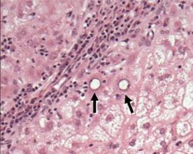 (A) (B) (C) Fig 5.2 Cryptogenic cirrhosis due to NAFLD. (A) Cirrhosis without fat is seen at low magnification.