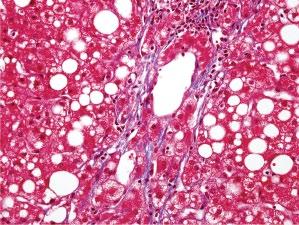 (A) Typical steatohepatitis with perivenular inflammation and