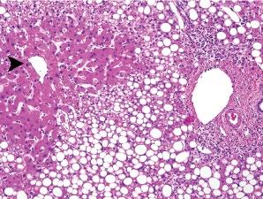 (B) Masson trichrome stain from the same case showing delicate zone