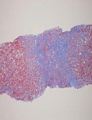 (B) In this example of several alcoholic hepatitis, there is very little steatosis, and one can appreciate near obliteration of all vascular (terminal hepatic