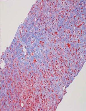 With close inspection, Mallory Denk bodies can be seen, as well as bile stained hepatocytes.