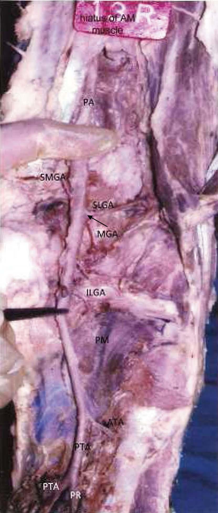 Inferior lateral genicular artery arising from high anterior tibial artery (Fig.1).