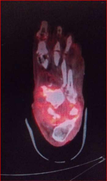 Nowadays the treatment of osteomyelitis is not completely standardized and evaluated case by case.