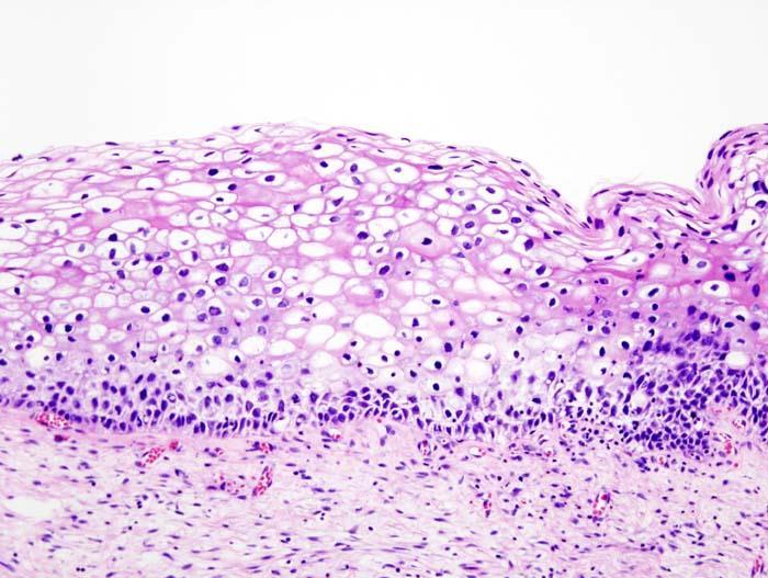 In mild dysplasia (CIN I) only a few cells are abnormal.