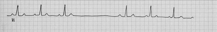 BRADYDYSRHYTHMIAS & ATRIOVENTRICULAR CONDUCTION BLOCKS 5 Fig. 5. Sinus pause. This rhythm strip demonstrates P waves preceding each QRS complex until a P-QRS-T complex is dropped.