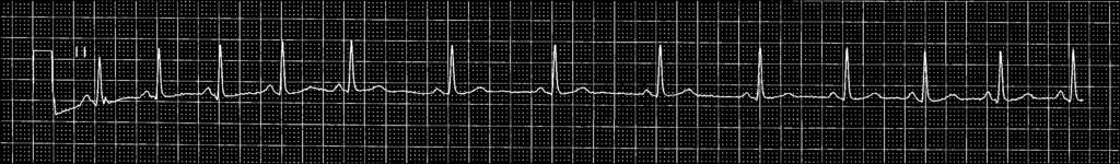 The P-P interval during the sinus pause is not a multiple of the baseline P- P interval on the ECG, which helps differentiate this rhythm from a second-degree SA block.