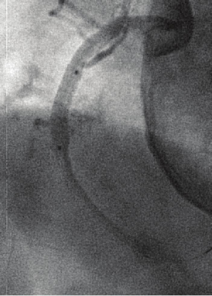 Intravascular ultrasound (IVUS) examination showed that the covered stent was well apposed to the first stent. The SB and its ostium could not be seen by IVUS (Figure 2(a)).