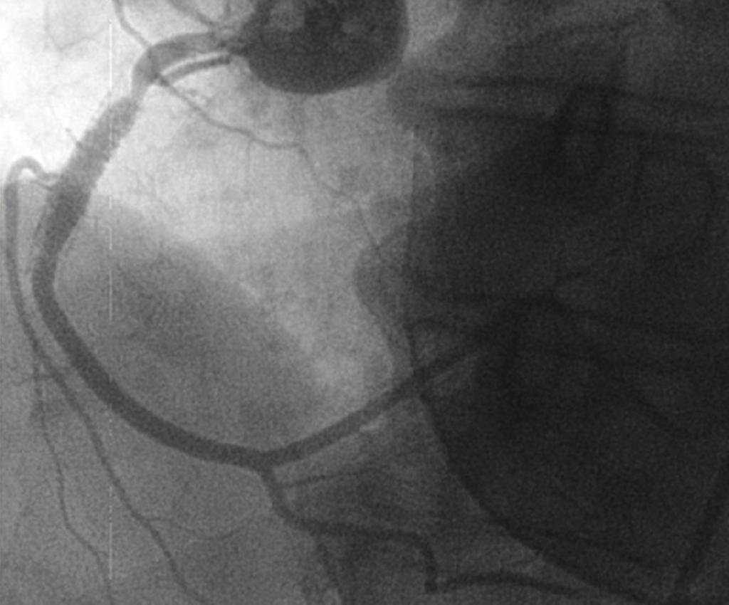 Ellis group III coronary perforation (perforation 1 mm in diameter with contrast streaming) is associated with higher rates of myocardial infarction, cardiac tamponade, and need for emergency